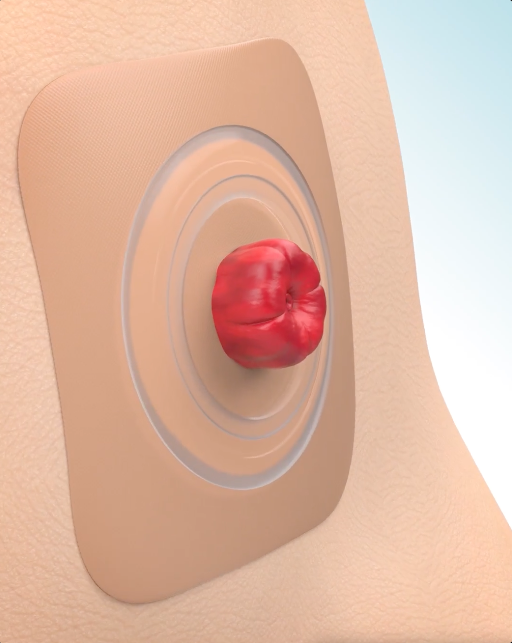 Video que demuestra cómo funcionan los adhesivos Convatec