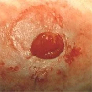 Tahriş Olmuş Peristomal Cilt