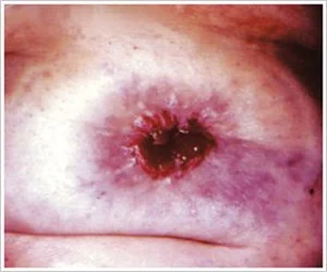 Eine Nahaufnahme der Haut einer Person mit Hautausschlag