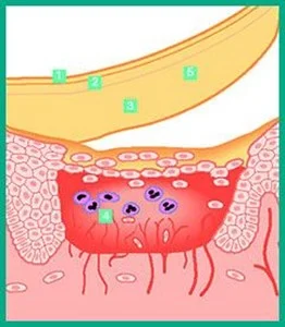 How DuoDERM Dressings work