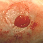 eine nahaufnahme der brust einer person mit einem roten ausschlag