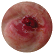retracted stoma